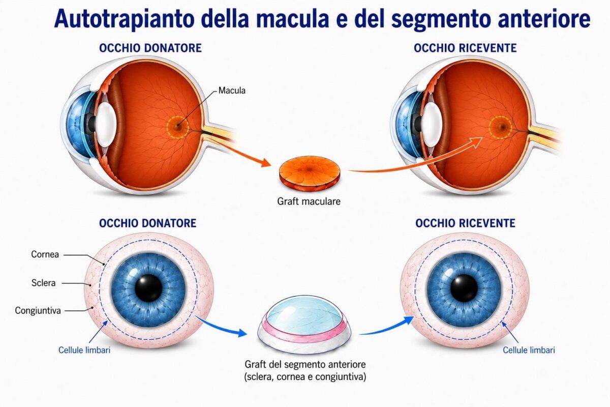 Turin: Patient regains sight following eye-to-eye transplant – a world first